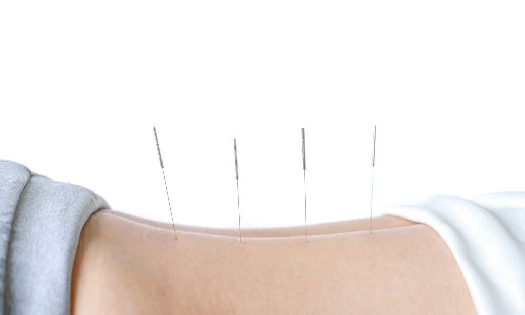 Acupuncture