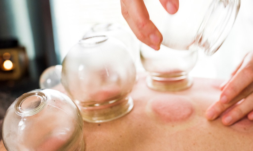 Cupping